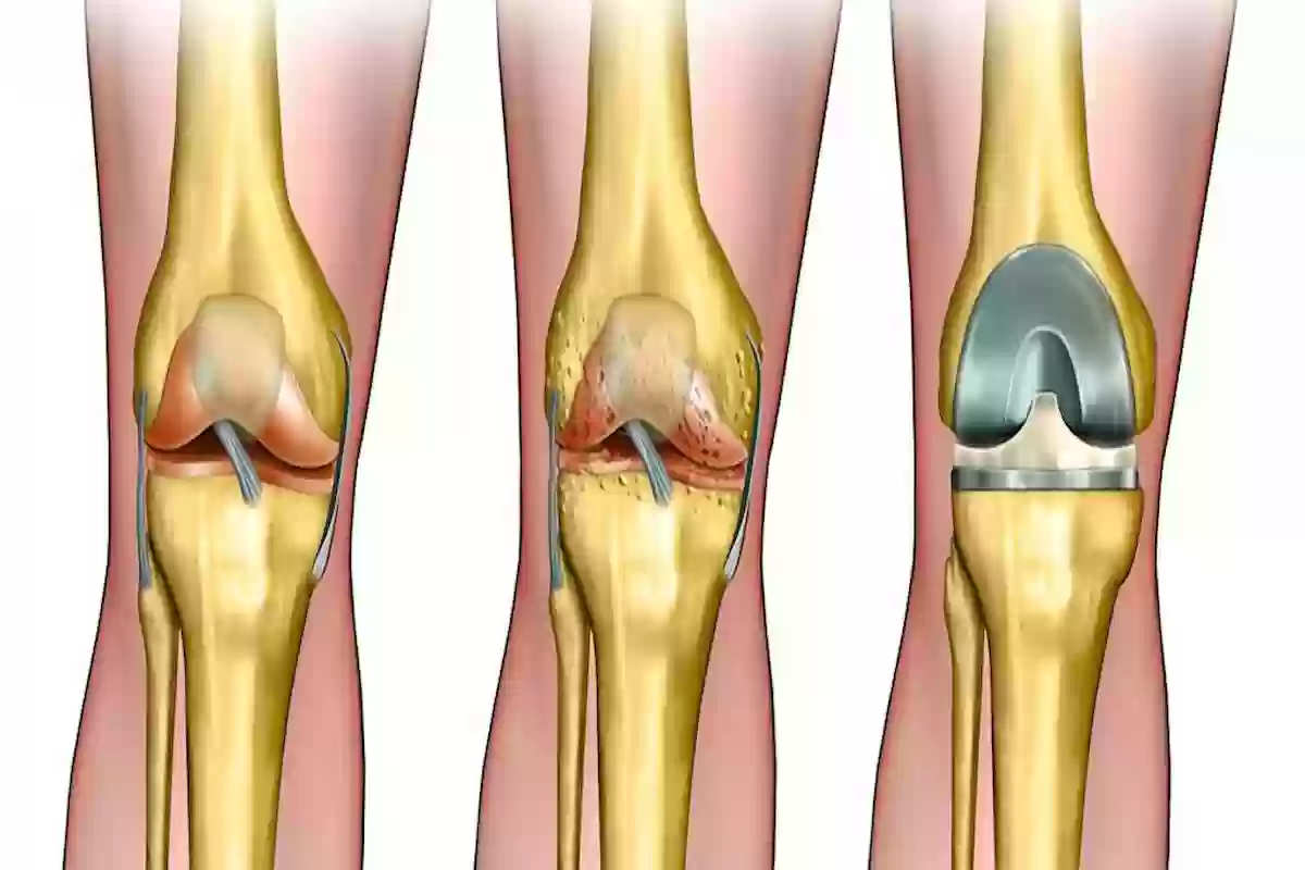 استشاري جراحة عظام يشجع مرضى خشونة الركبة على إجراء هذه العملية!